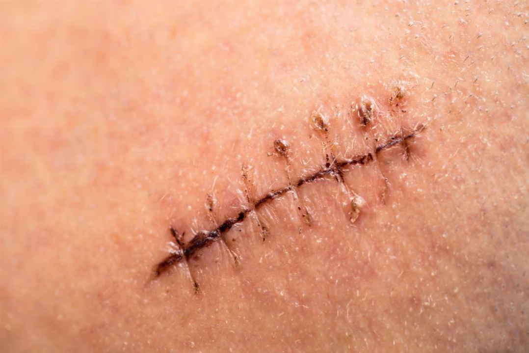 Ablation de point de suture : tout ce qu’il faut savoir